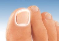 batık tırnak tedavisi